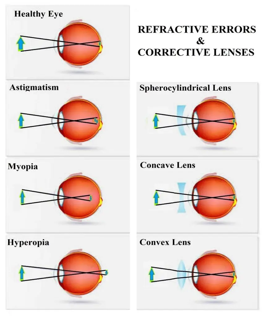 Light focusing patterns and corrective lenses for each refractive error