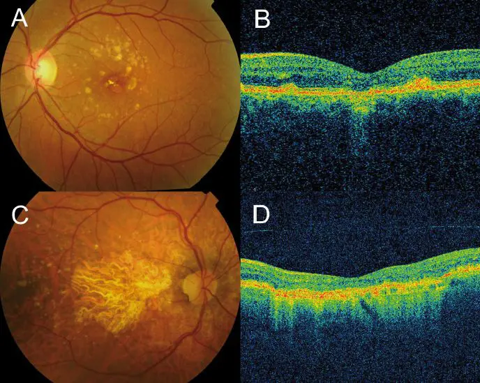 Retinal scan and OCT image of macular degeneration