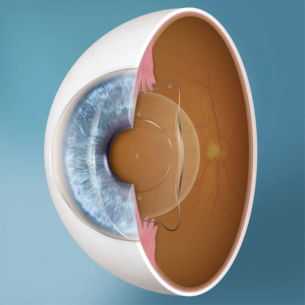 Illustration of Phakic ICL lens placement between iris and natural lens
