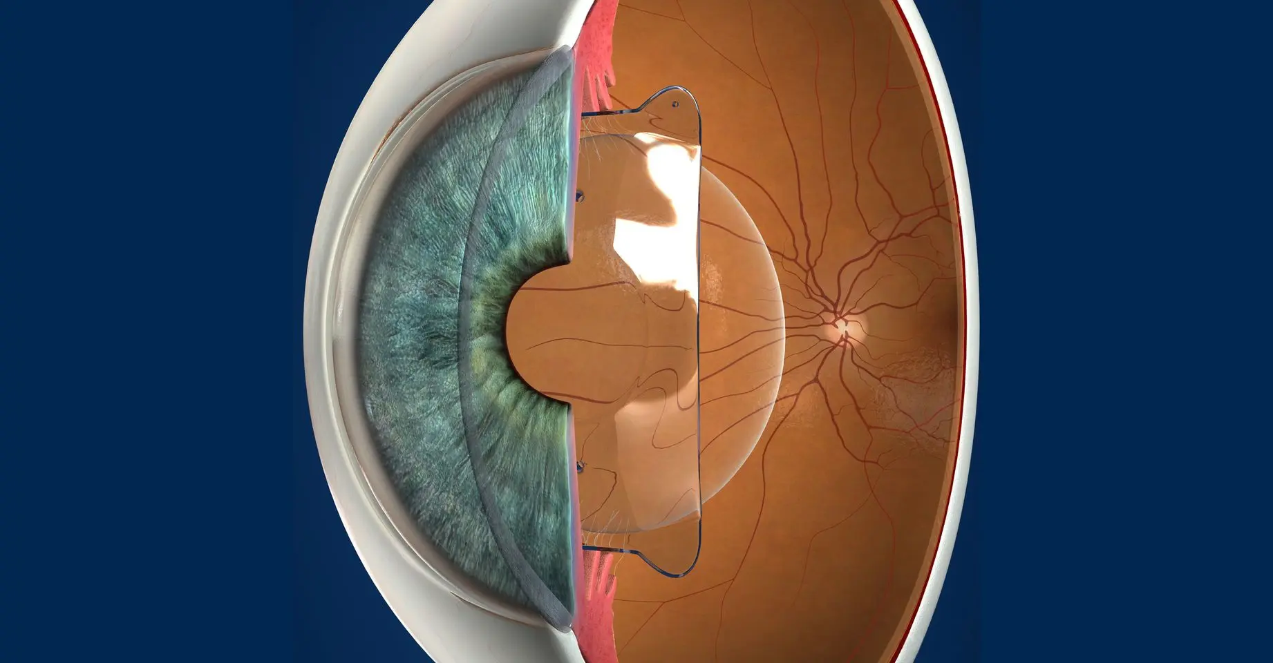 Mô phỏng Phakic ICL điều chỉnh loạn thị từ bên trong mắt