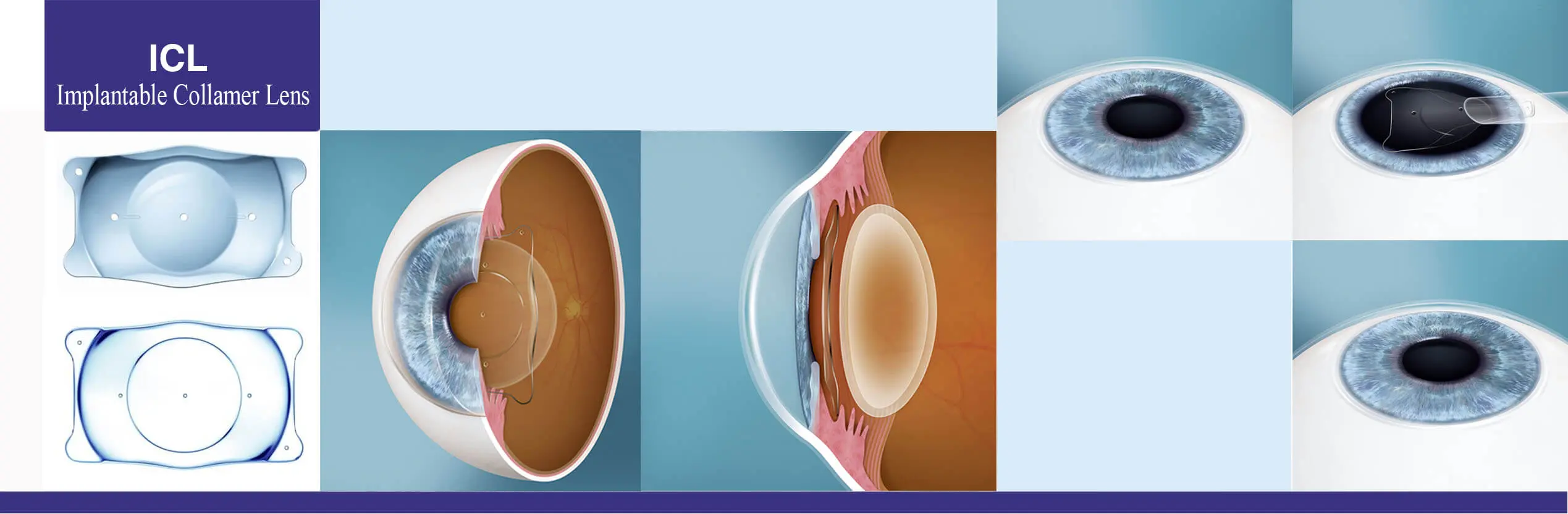 Mô phỏng vị trí đặt thấu kính Phakic ICL trong mắt