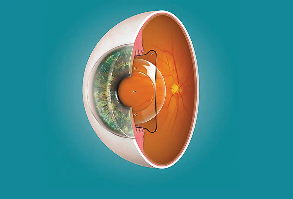 Position of the Phakic ICL lens inside the human eye
