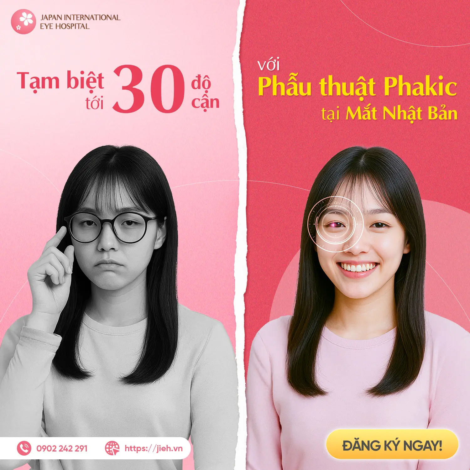 Phakic ICL – Giải pháp xoá cận tới 30 độ tại Bệnh viện Mắt Quốc Tế Nhật Bản