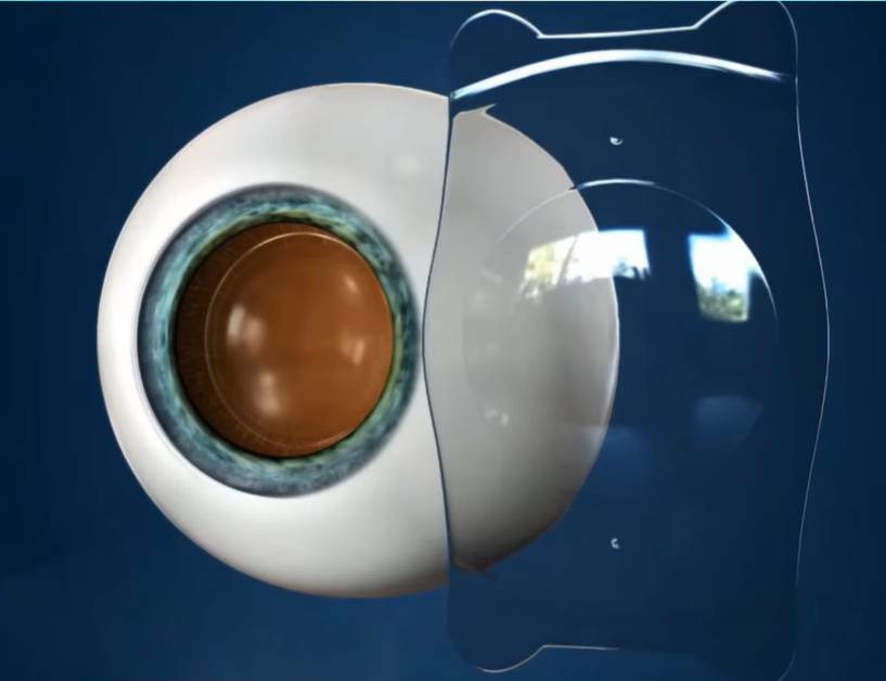 Thấu kính Phakic ICL