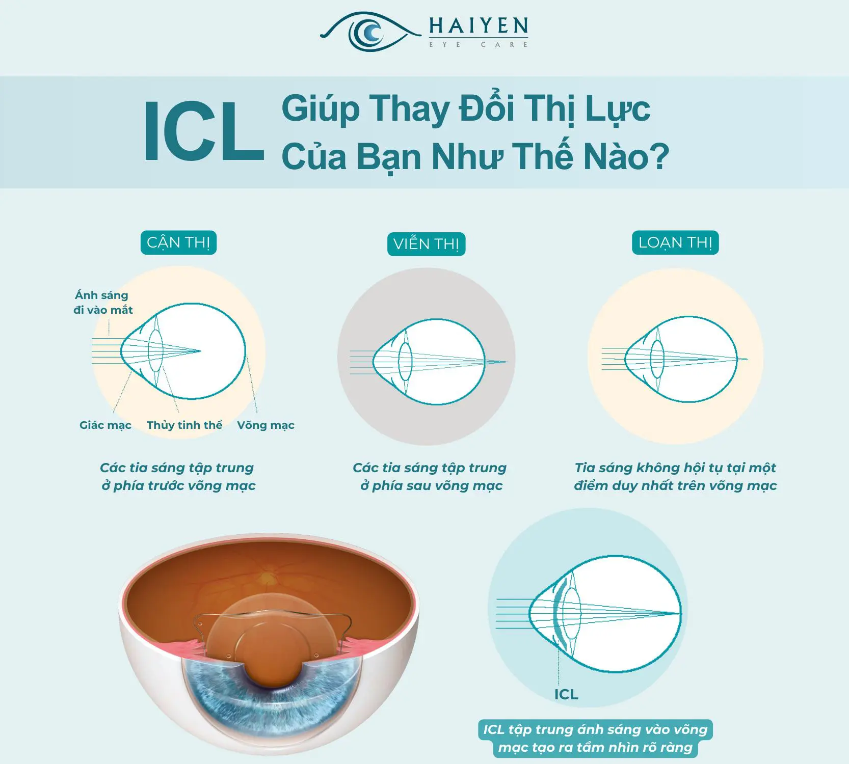 Phakic ICL giúp thay đổi thị lực của bạn như thế nào?