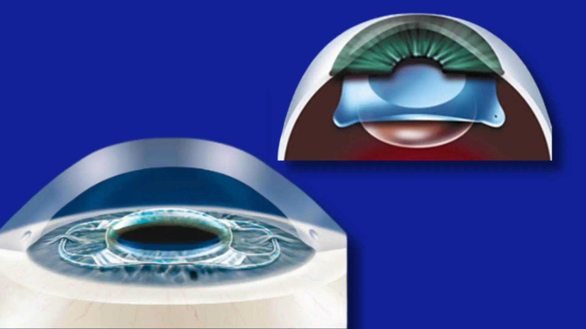 After Phakic surgery, doctors will prescribe antibiotic, anti-inflammatory, and lubricating eye drops.