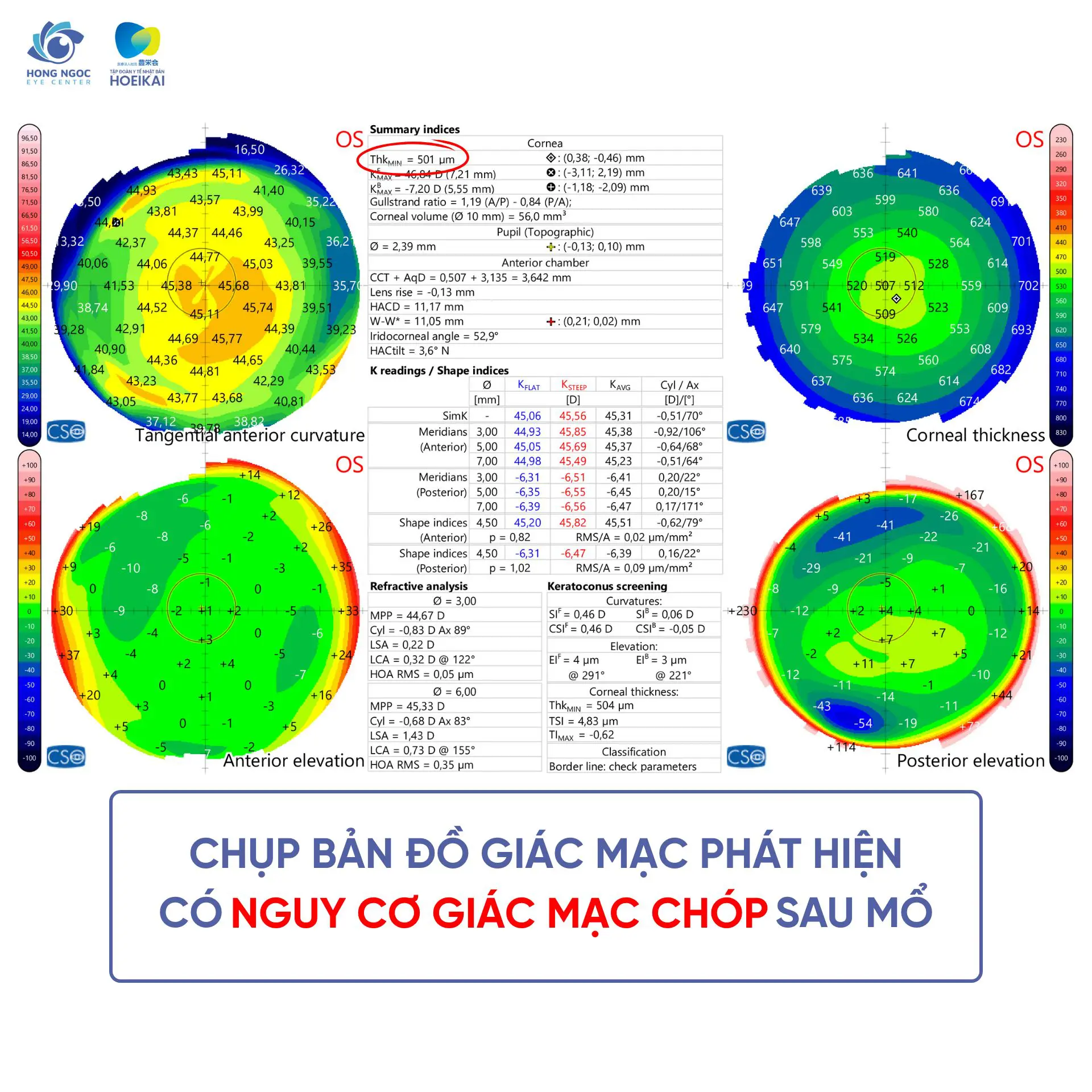 Trải nghiệm mổ cận Phakic ICL của chị H tại Bệnh viện Đa khoa Hồng Ngọc