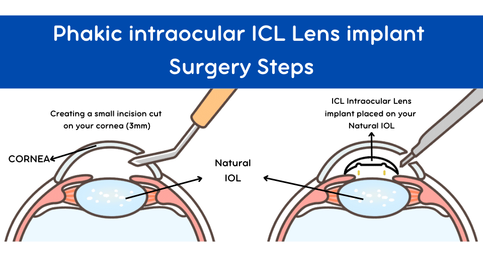 Steps of Phakic ICL surgery