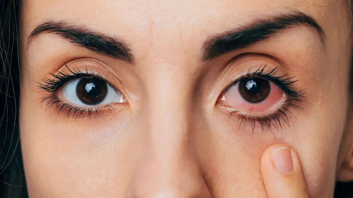 Phakic Premium phù hợp với người có khô mắt hoặc nguy cơ khô mắt cao