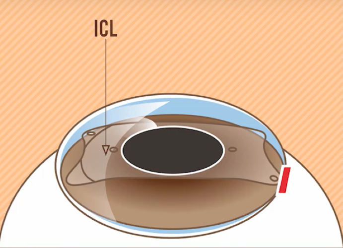 Phẫu thuật Phakic ICL là gì?