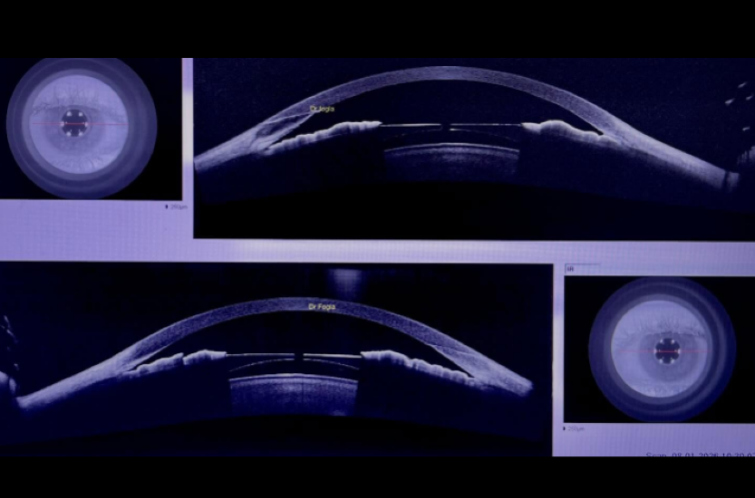Theo dõi 5 năm sau khi cấy ghép thủy tinh thể nội nhãn Visian ICL (phakic).