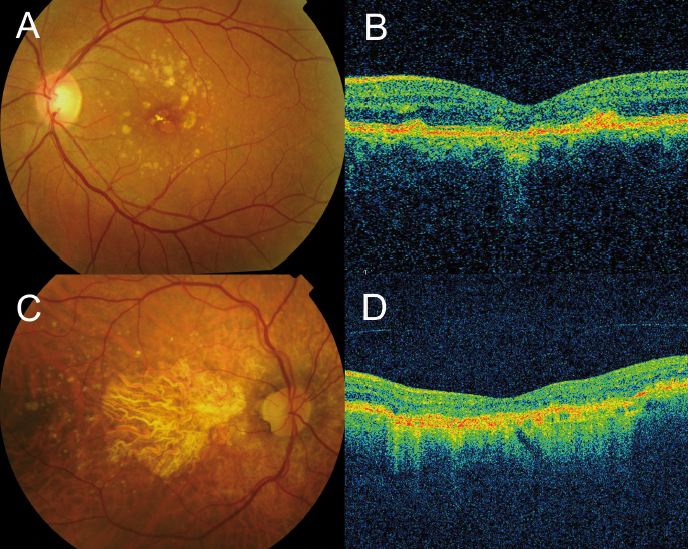Retinal scan and OCT image of macular degeneration