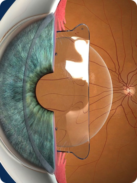 Hình ảnh thấu kính nội nhãn Phakic ICL đặt sau mống mắt