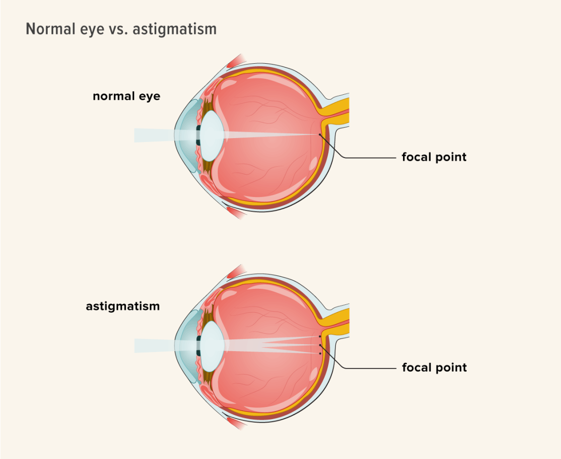 Ánh sáng tán xạ ở mắt loạn thị gây mờ hình, nhòe sáng