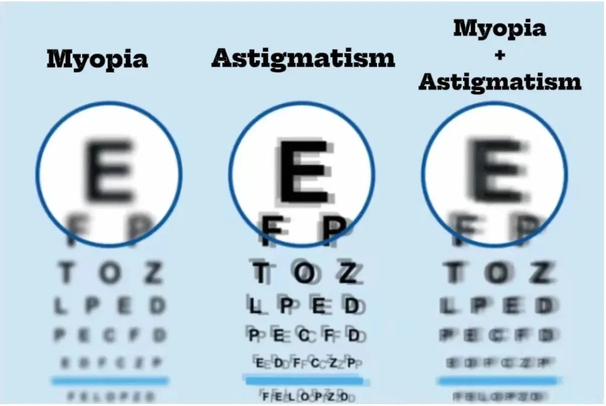 So sánh thị lực: Cận thị – Loạn thị – Cận kèm loạn.