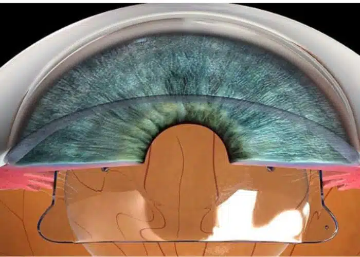 Simulation of Phakic ICL lens placement inside the eye