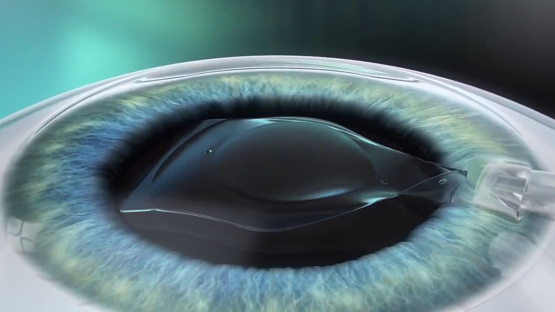 Simulation of Phakic ICL lens implantation between the iris and natural lens.