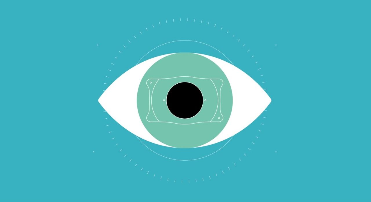 Phakic ICL – Thấu kính Collamer mềm mại, trong suốt, đặt sau mống mắt và trước thể thủy tinh, mang lại tầm nhìn rõ nét, tự nhiên mà không gây tổn thương giác mạc