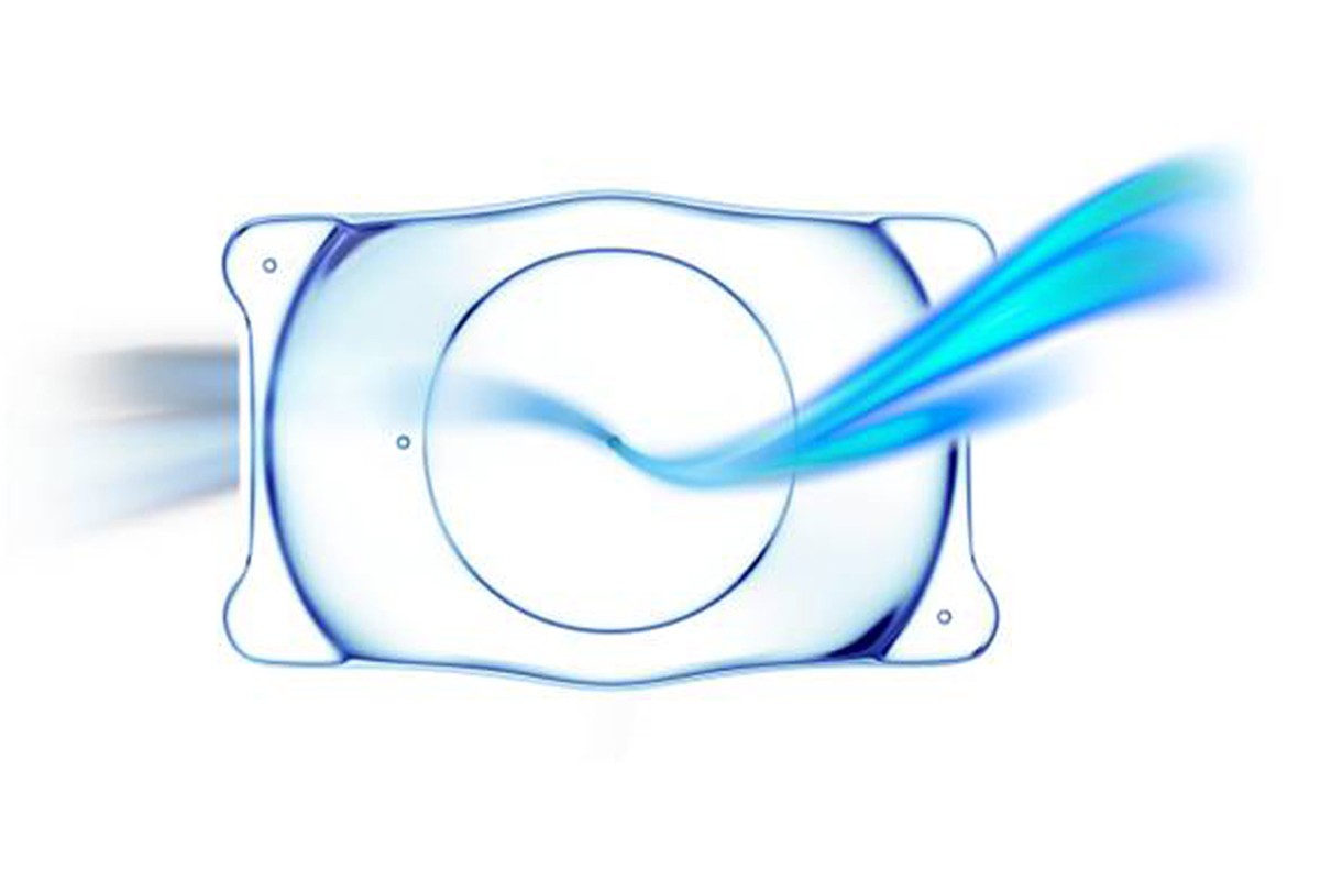 Thấu kính Phakic IPCL với thiết kế mỏng, linh hoạt, giúp điều chỉnh cận – loạn hiệu quả.