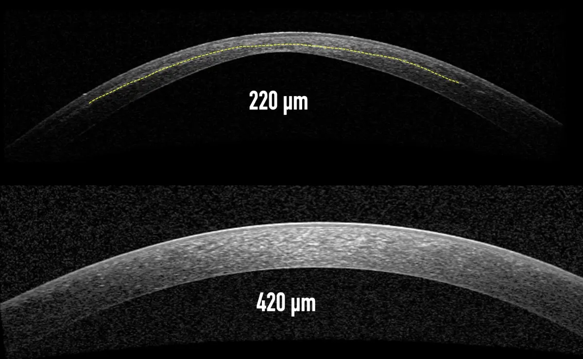 So sánh độ dày giác mạc qua hình ảnh chụp cắt lớp