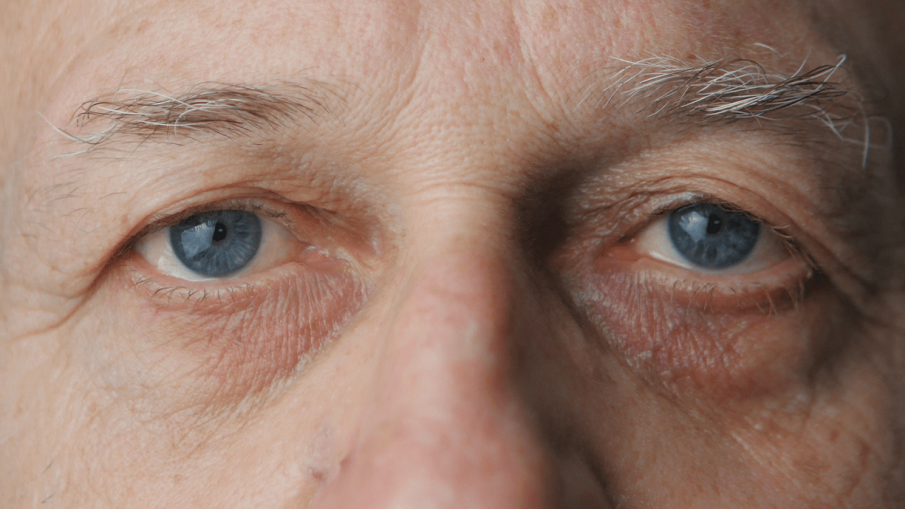 Cataracts are the most common eye disease among older adults