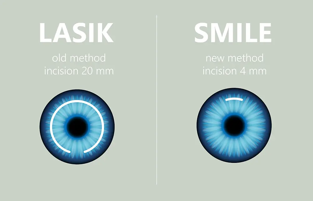 So sánh đường rạch giác mạc giữa LASIK (20mm) và SMILE (4mm)