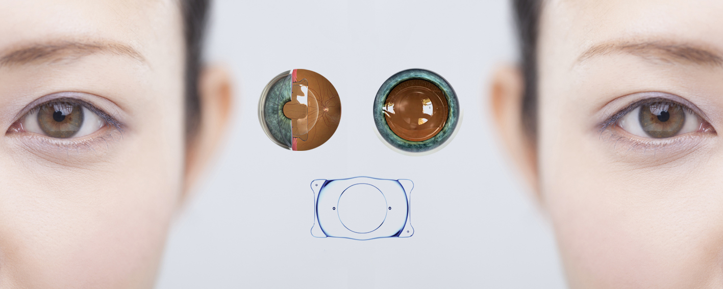 Phẫu thuật Phakic ICL hoàn toàn không khiến mắt tái cận