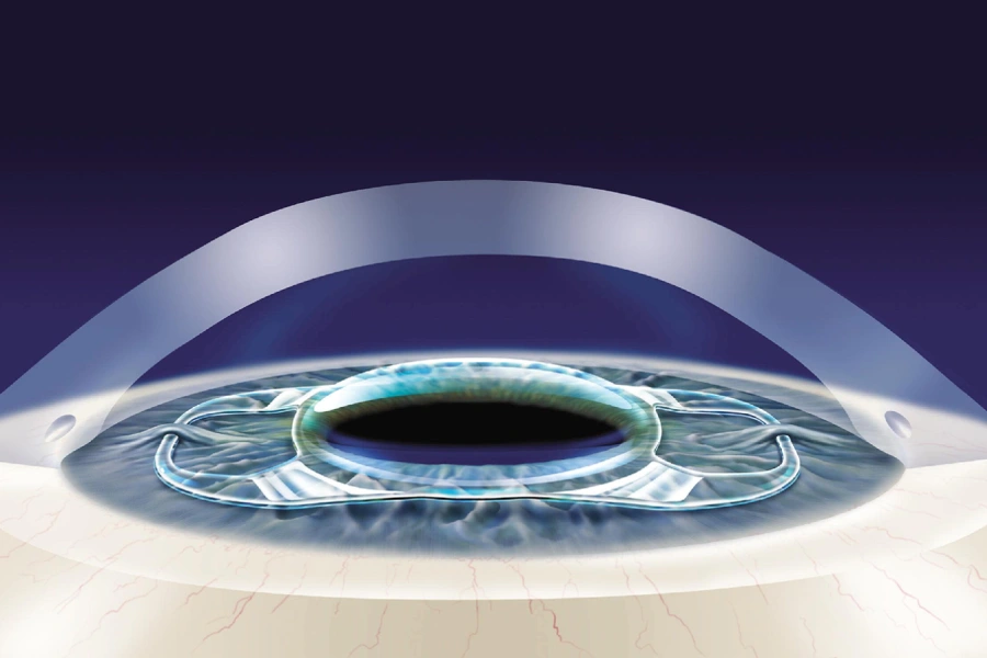 Thấu kính Phakic ICL trong mắt