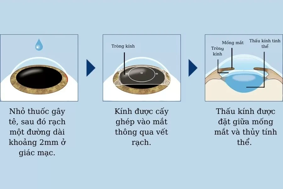 Phakic ICL myopia surgery process