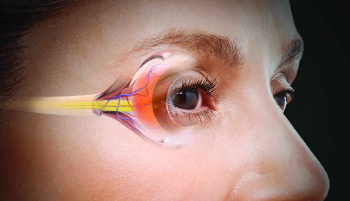 Phakic ICL minimally affects the corneal surface, limiting disturbance to the corneal nerves.