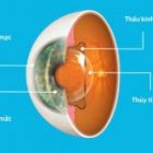 Phakic ICL là gì? Ưu và nhược điểm của phương pháp này