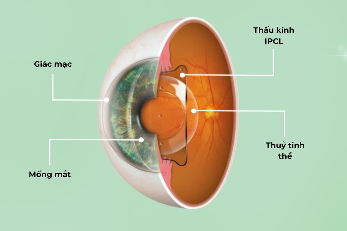 Thấu kính Collamer sinh học trong mắt