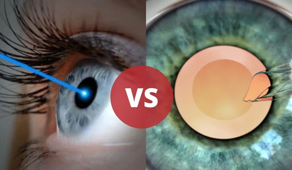 So sánh tốc độ hồi phục giữa Phakic ICL và LASIK