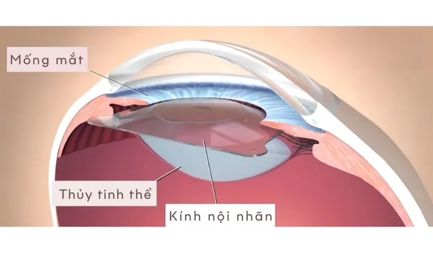 Phẫu thuật mắt Phakic ICL được áp dụng cho những người mắc cận thị và loạn thị từ 18 tuổi trở lên.