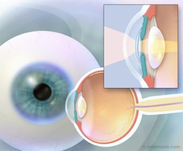 Ưu điểm nổi bật của Phakic - Review mổ cận với ICL