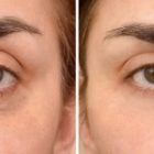 How does ocular accommodation differ between ages 20 and 50?