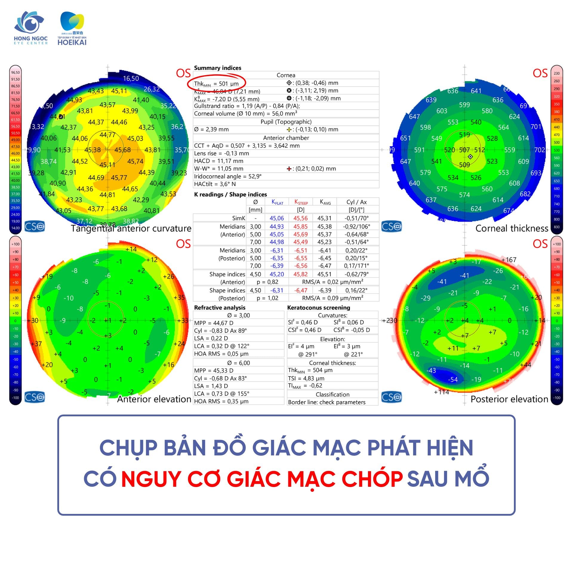 Trải nghiệm mổ cận Phakic ICL của chị H tại Bệnh viện Đa khoa Hồng Ngọc