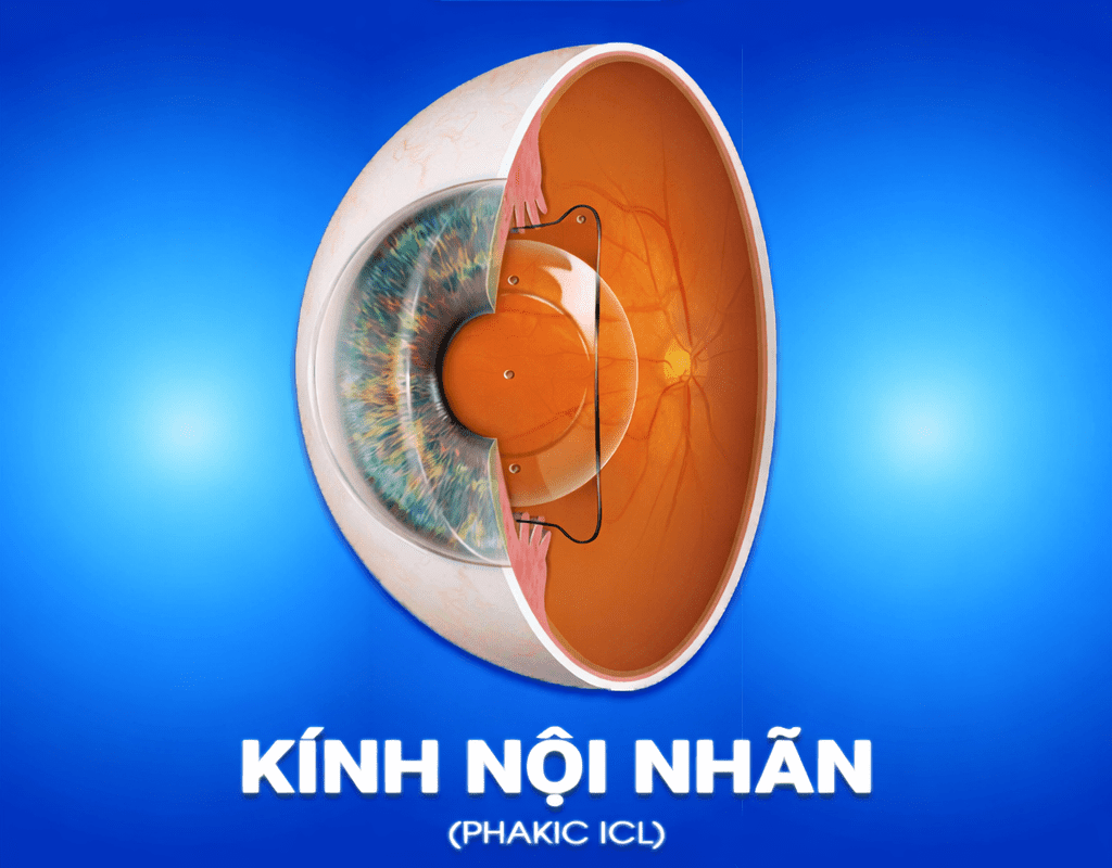 Kính nội nhãn Phakic ICL phù hợp cho tật khúc xạ phức tạp