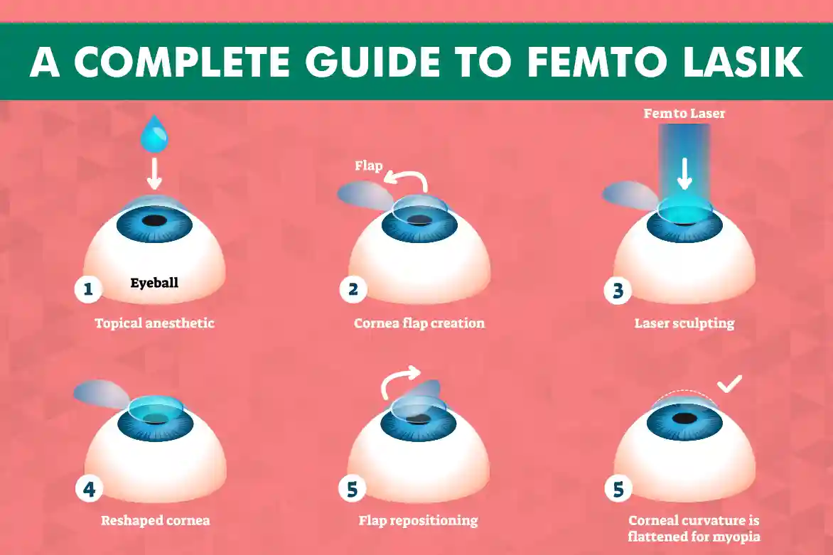 Steps involved in FEMTO LASIK surgery