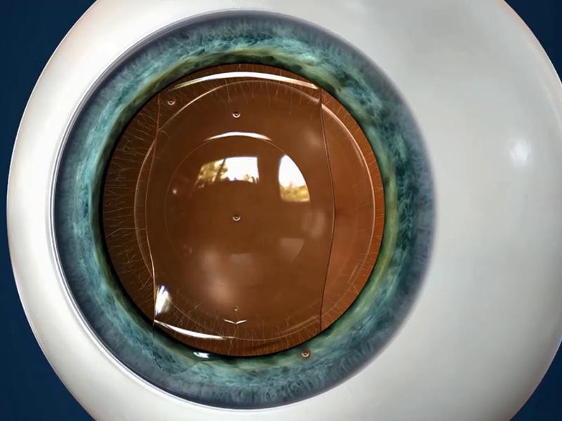 Thấu kính Phakic ICL trong mắt