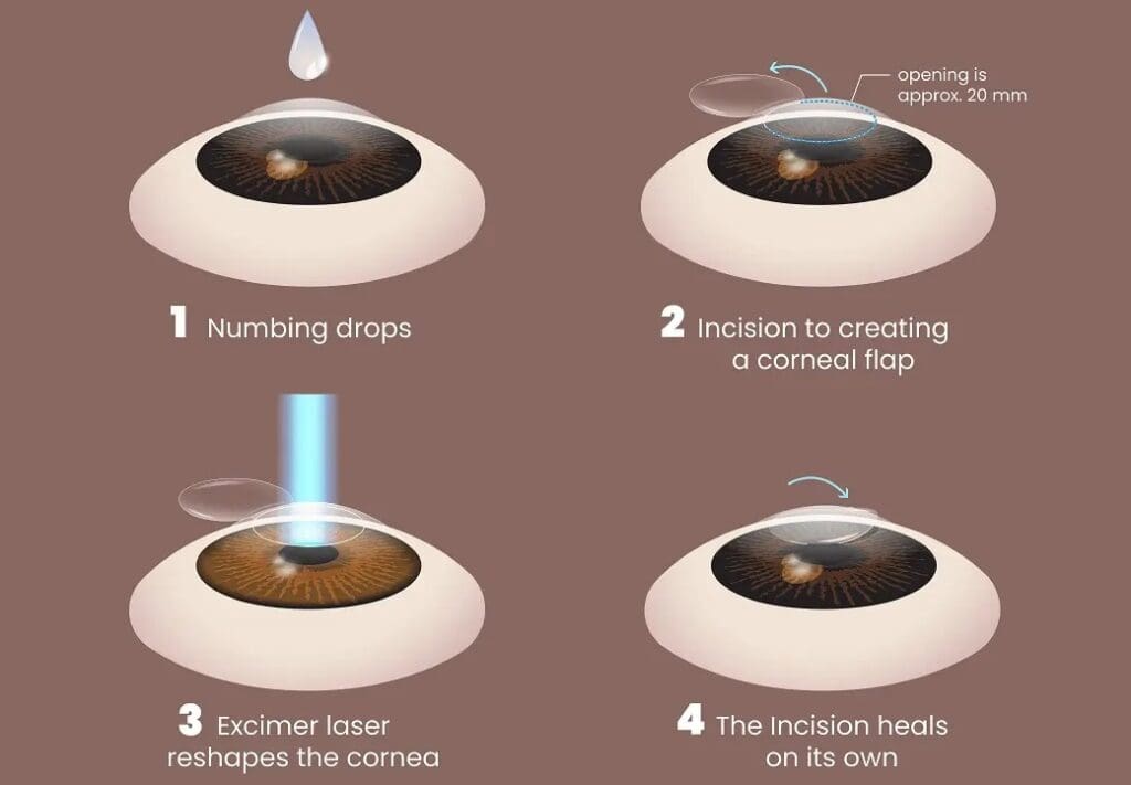 Steps involved in SMILE surgery