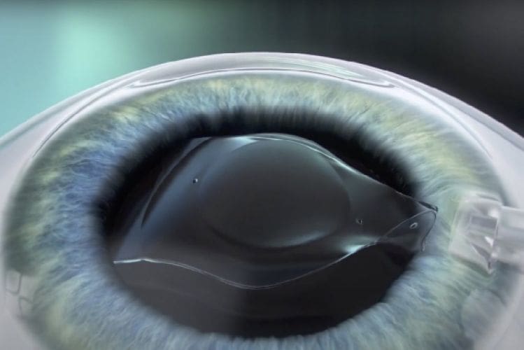 Thấu kính ICL trong mắt