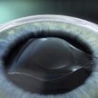 Review mổ cận 10 độ với Phakic ICL