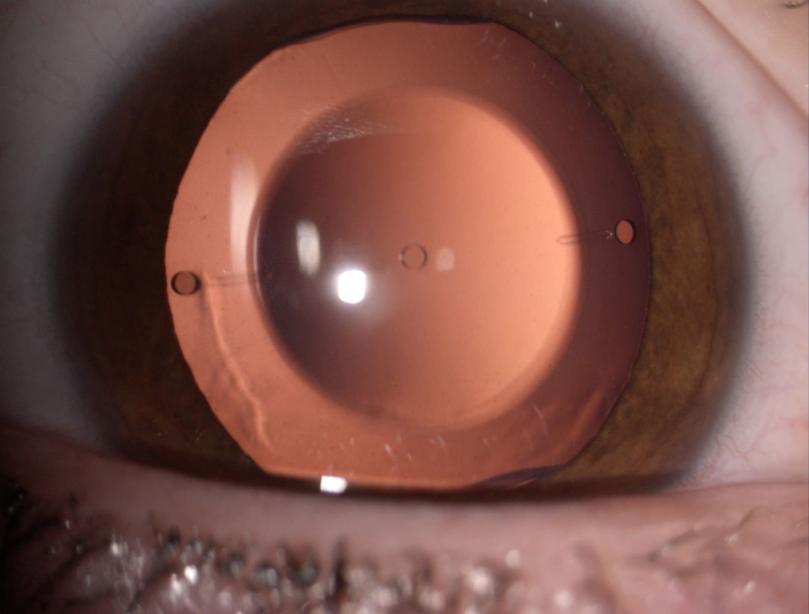 Mổ Phakic ICL là gì?