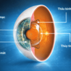 Các phương pháp xóa cận tốt nhất 2026