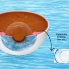 Vật liệu Collamer là gì? Tính ứng dụng trong Phakic ICL