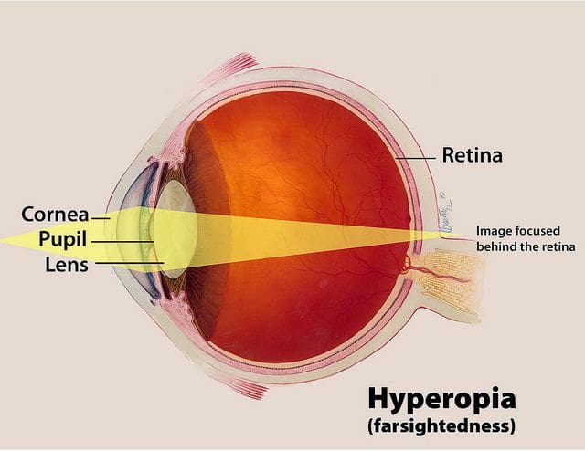 What is hyperopia? Why are hyperopia and presbyopia often confused?