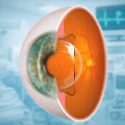 PHAKIC ICL – GIẢI PHÁP CHO NGƯỜI CẬN NẶNG, GIÁC MẠC MỎNG