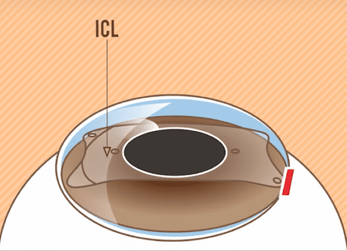 Phẫu thuật Phakic ICL là gì?