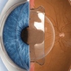 Vì sao Phakic ICL 2026 được giới chuyên môn đánh giá cao?